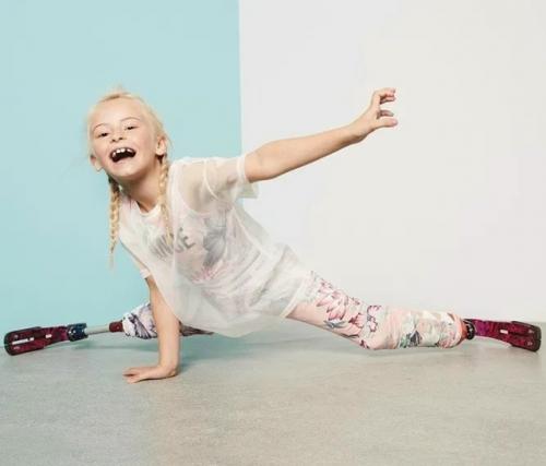 Дэйзи - Мэй Деметре родилась в Великобритании с недоразвитыми малоберцовыми костями. 02