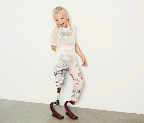 Дэйзи - Мэй Деметре родилась в Великобритании с недоразвитыми малоберцовыми костями. 05