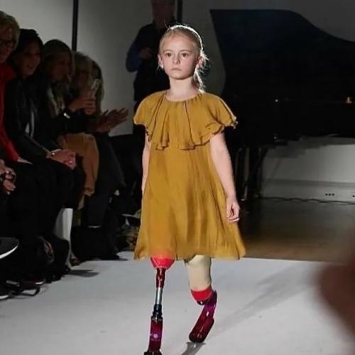 Дэйзи - Мэй Деметре родилась в Великобритании с недоразвитыми малоберцовыми костями. 03