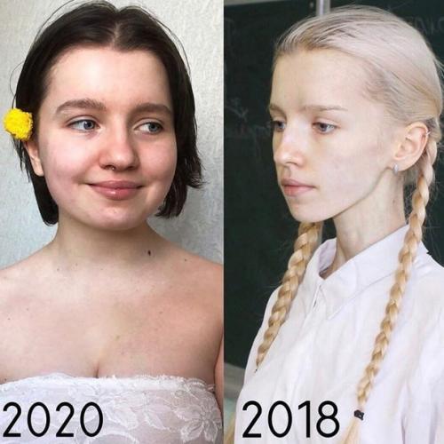 Эта красотка сумела побороть анорексию. 01